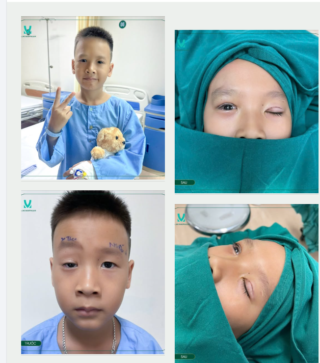 KẾT QUẢ SAU PHẪU THUẬT TREO MI VCT MẮT PHẢI KẾT HỢP CẮT MÍ MẮT TRÁI