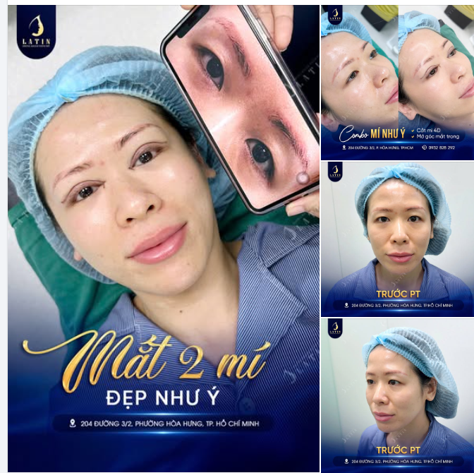 COMBO CẮT MÍ 4D + MỞ GÓC MẮT TRONG – ĐẶT LẠI NẾP MÍ, MỞ RÕ ĐẦU MẮT