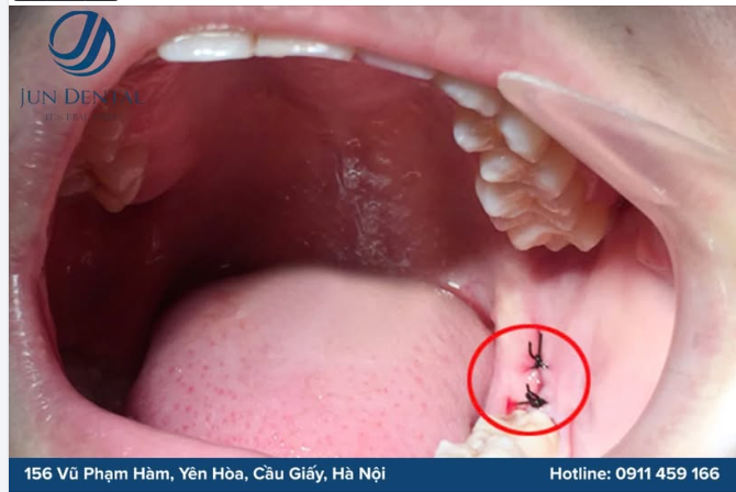 NHỔ RĂNG KHÔN BAO LÂU THÌ LÀNH?