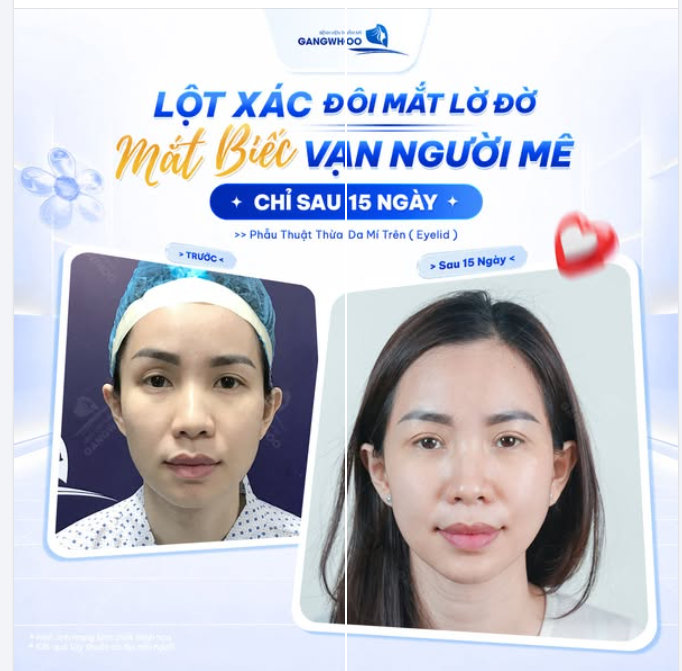 LỘT XÁC ĐÔI MẮT LỜ ĐỜ THÀNH MẮT BIẾC VẠN NGƯỜI MÊ