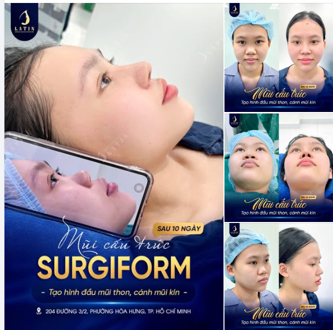 FEEDBACK MŨI CẤU TRÚC SAU 10 NGÀY – ĐẦU MŨI GỌN, MÔI VÀO TỶ LỆ HƠN