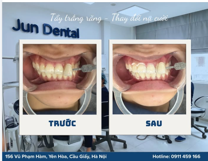 TẨY TRẮNG RĂNG – THAY ĐỔI NỤ CƯỜI