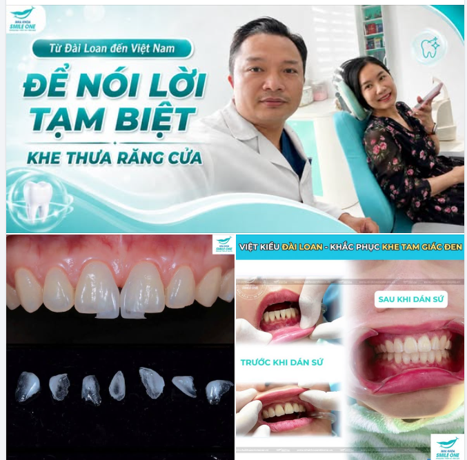 TỪ ĐÀI LOAN VỀ VIỆT NAM – TẠM BIỆT KHE THƯA RĂNG CỬA VỚI VENEER NON-PREP
