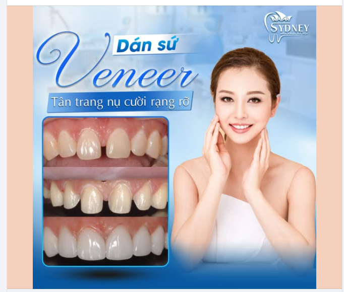 DÁN SỨ VENEER - TÂN TRANG NỤ CƯỜI RẠNG RỠ