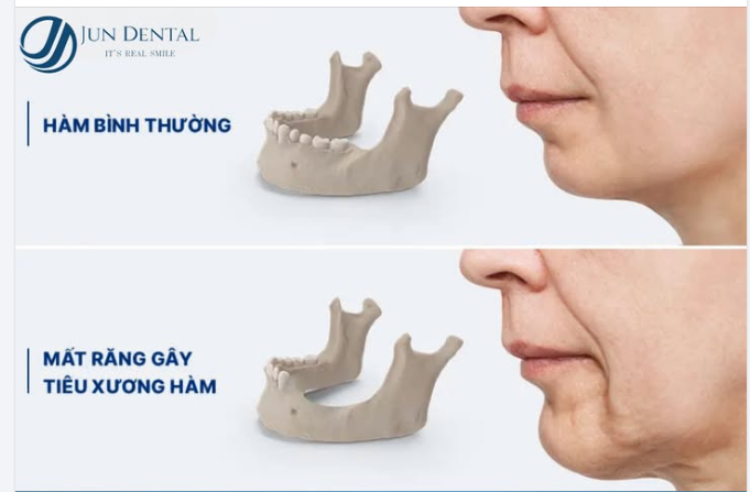 MẤT RĂNG – KHÔNG CHỈ LÀ VẤN ĐỀ THẨM MỸ!