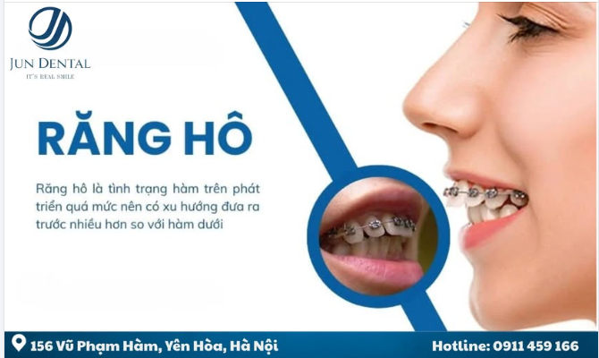 RĂNG HÔ – NGUYÊN NHÂN GIẢI PHÁP HIỆU QUẢ