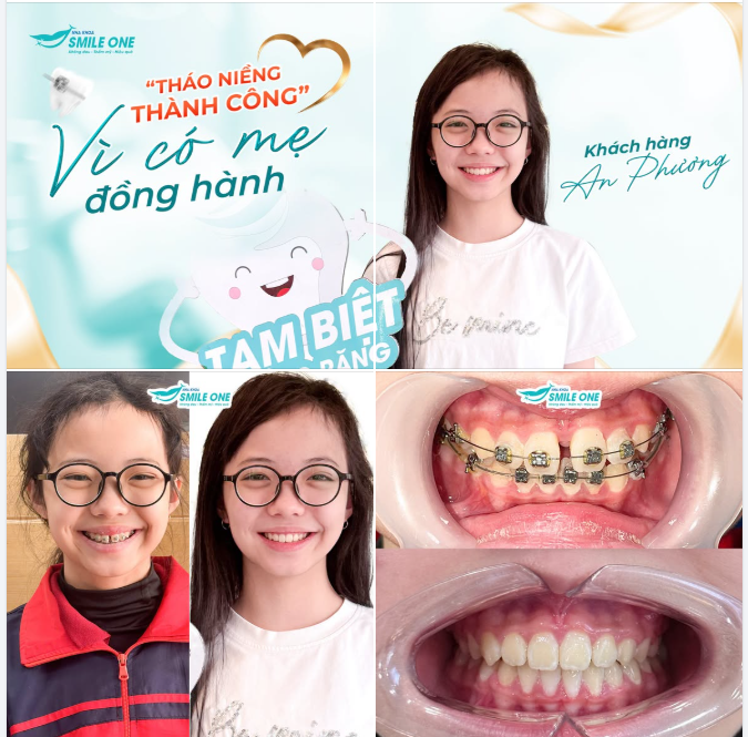 Có mẹ đồng hành, hành trình niềng của con trở nên nhẹ nhàng hơn.
