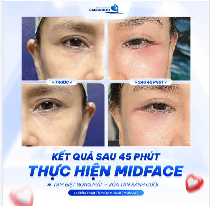KẾT QUẢ SAU 45 PHÚT THỰC HIỆN MIDFACE