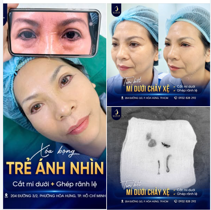 TẠM BIỆT MÍ DƯỚI CHẢY XỆ VÀ RÃNH LỆ SÂU:  GIẢI MÃ CÔNG NGHỆ LẤY LẠI 10 NĂM THANH XUÂN