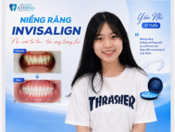 NIỀNG RĂNG INVISALIGN – NỤ CƯỜI TỰ TIN, TỎA SÁNG TƯƠNG LAI!