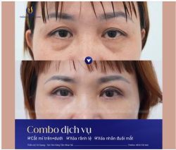 Tạm biệt mí nhiễu đa nếp mí, đánh bay bọng mắt chỉ sau 30 phút!