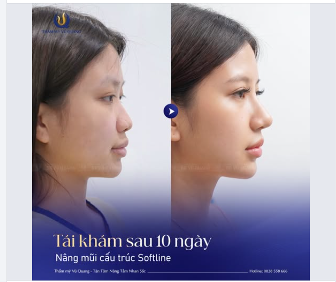 Nàng 2K6 Hà Nội nhà mình vừa khoe chiếc mũi Softline đẹp tự nhiên sau 10 ngày kiến tạo tại Thẩm mỹ Vũ Quang.