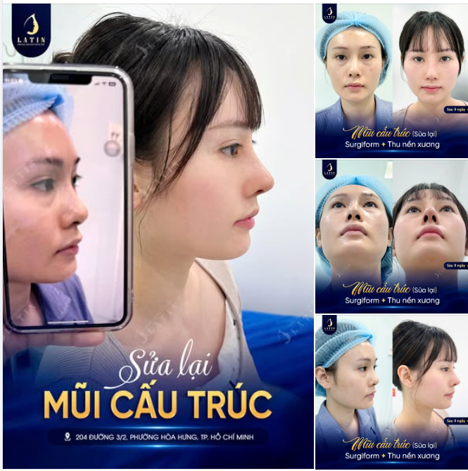 Có những chiếc mũi không cần nâng cao thêm, điều cần nhất là đưa các đường nét trở về đúng vị trí.