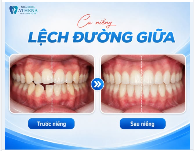ĐƯỜNG GIỮA LỆCH – NIỀNG RĂNG CÓ CHỈNH ĐƯỢC KHÔNG?