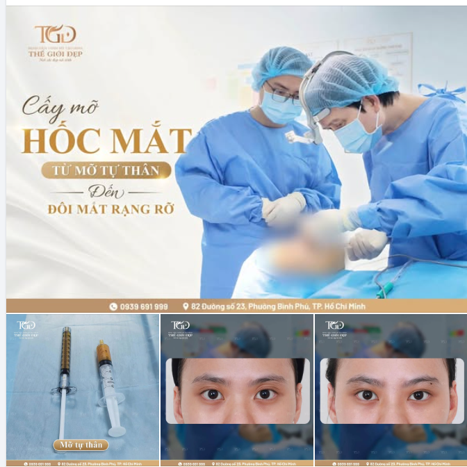 Cấy mỡ hốc mắt – Từ m.ỡ tự thân đến đôi mắt rạng rỡ