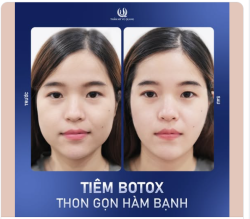 TẠM BIỆT GƯƠNG MẶT GÓC CẠNH - NGAY SAU KHI TIÊM GỌN GÓC HÀM
