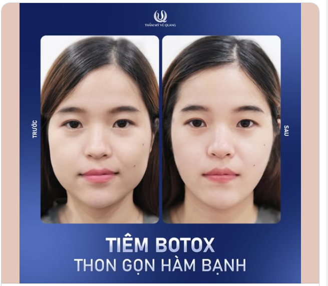 TẠM BIỆT GƯƠNG MẶT GÓC CẠNH - NGAY SAU KHI TIÊM GỌN GÓC HÀM