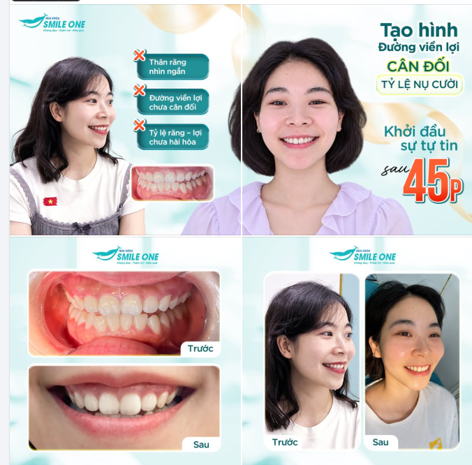 RĂNG NGẮN, TỶ LỆ NỤ CƯỜI CHƯA HÀI HÒA – CÓ THỂ CẢI THIỆN THẾ NÀO?