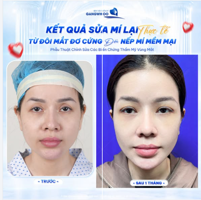 THỰC TẾ KẾT QUẢ SỬA MÍ LẠI TẠI BVTM GANGWHOO
