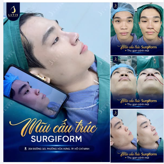 MŨI CẤU TRÚC SURGIFORM KẾT HỢP THU GỌN C.ÁNH MŨI