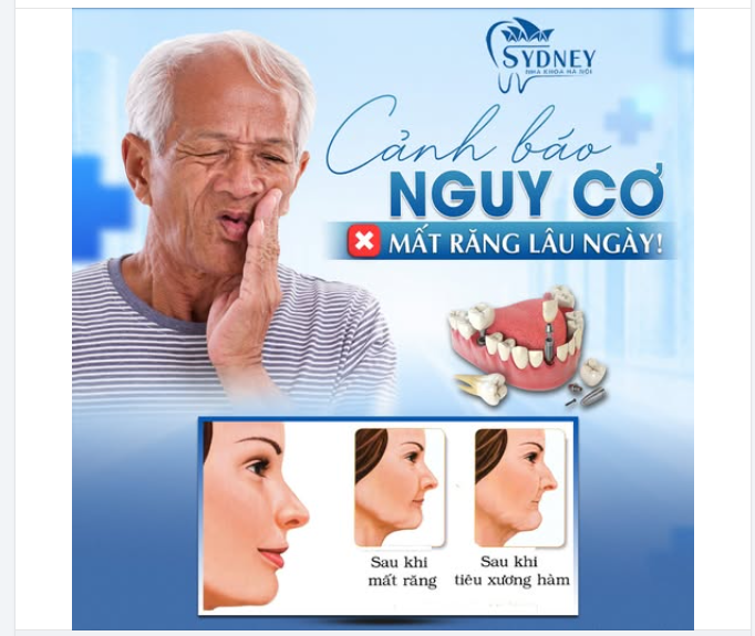 CẢNH BÁO: NGUY CƠ MẤT RĂNG LÂU NGÀY!
