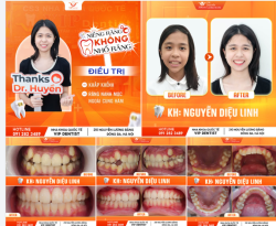 NIỀM VUI X2 - VỪA CÓ RĂNG ĐỀU ĐẸP - VỪA KHÔNG PHẢI NHỔ RĂNG