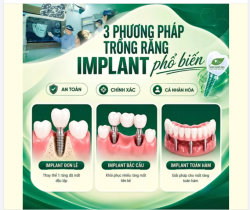 3 PHƯƠNG PHÁP TRỒNG RĂNG IMPLANT PHỔ BIẾN NHẤT HIỆN NAY