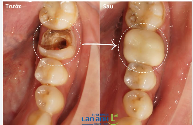 Răng số 6 - Cố gắng để được ở lại  Răng số 6 đến với chúng ta từ khi còn rất bé,