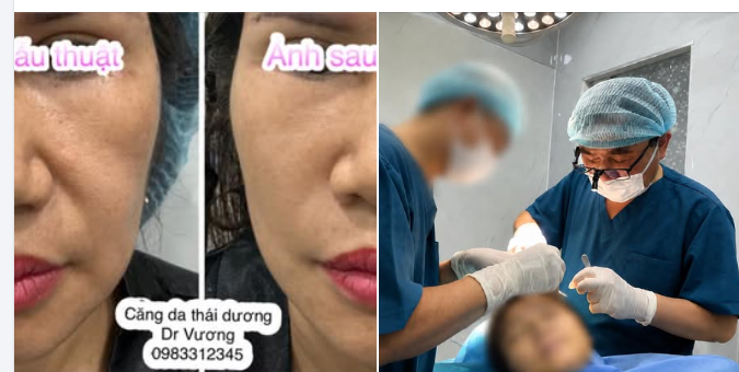 CĂNG DA THÁI DƯƠNG PHẪU THUẬT – NÂNG MÔ THẬT (KHÔNG PHẢI TREO CHỈ)