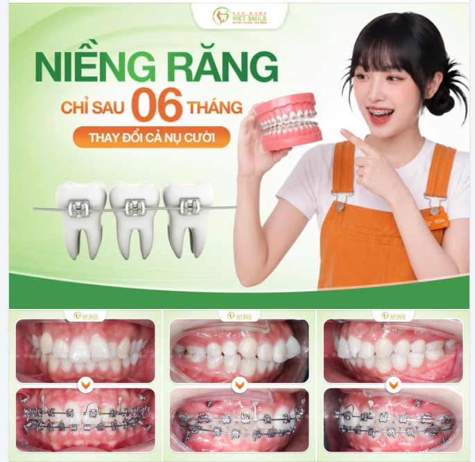 NHỮNG CHIẾC RĂNG LỆCH LẠC CÓ GIÚP BẠN TỰ TIN?