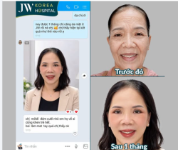 KHÔNG AI TIN: QUÝ CÔ U60 CẢI LÃO 20 TUỔI CHỈ SAU 90 PHÚT CĂNG DA MẶT SMAS PRO TẠI JW