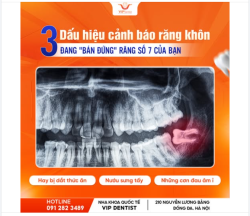 RĂNG KHÔN ĐANG "BÁN ĐỨNG" RĂNG SỐ 7 CỦA BẠN - ĐỪNG CHỦ QUAN!