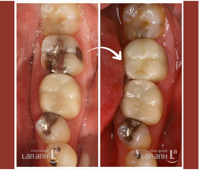 THAY MIẾNG TRÁM AMALGAM BỊ HỞ BẰNG SỨ - GIẢI PHÁP PHỤC HỒI HIỆN ĐẠI
