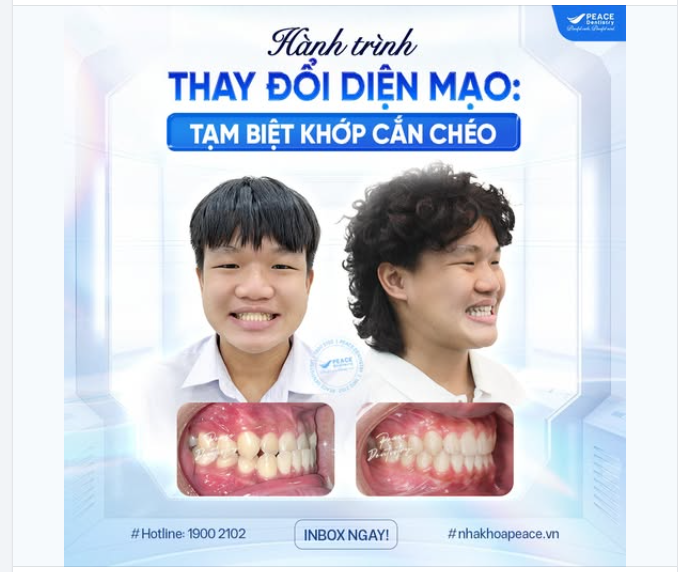 THAY ĐỔI RÕ RỆT SAU KHI NIỀNG RĂNG ĐIỀU CHỈNH KHỚP CẮN