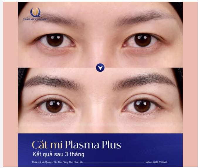 Lột xác ngoạn mục sau 3 tháng cắt mí Plasma Plus!