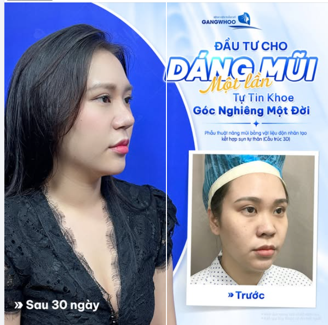ĐẦU TƯ CHO DÁNG MŨI 1 LẦN