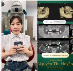 ĐẦU TUẦN "CHỐT ĐƠN" RỰC RỠ - 3 TRỤ IMPLANT VỀ ĐỘI CỦA CHỊ HUYỀN!