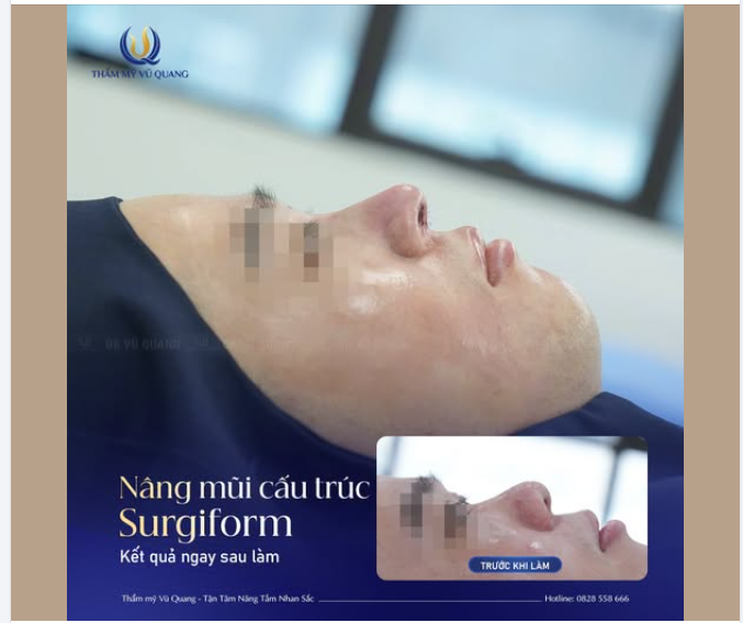 Một dáng mũi đẹp chính là trợ thủ đắc lực giúp nâng tầm thần thái và sự tự tin.