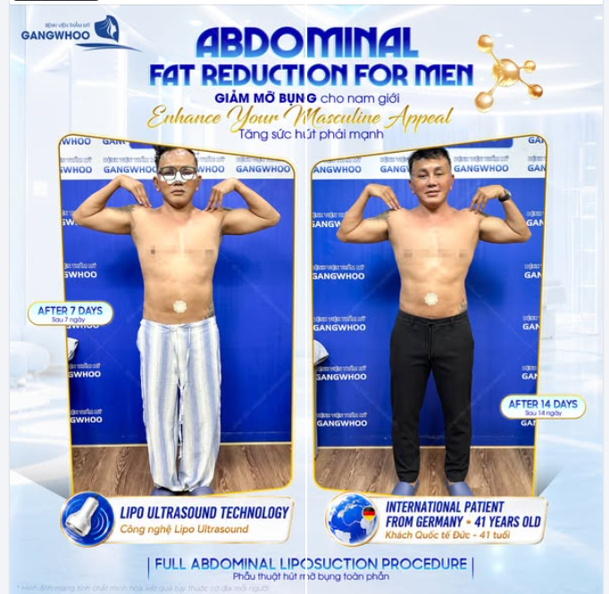 Đối với nam giới, việc tích tụ mỡ thừa vòng 2 không chỉ ảnh hưởng đến ngoại hình mà còn làm giảm đi sự tự tin vốn có của phái mạnh.
