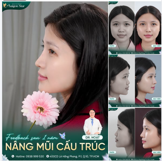 NHUẬN SẮC SAU 1 NĂM NÂNG MŨI CẤU TRÚC DR. HOẠT