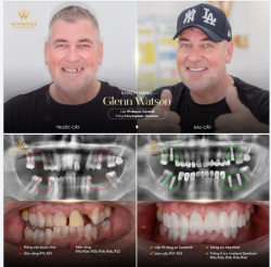 GLENN WATSON * HÀNH TRÌNH THAY ĐỔI NỤ CƯỜI Ở TUỔI 62