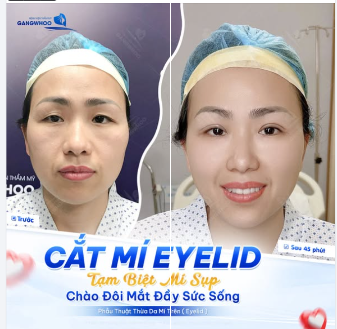TẠM BIỆT MÍ SỤP - CHÀO ĐÔI MẮT ĐẦY SỨC SỐNG