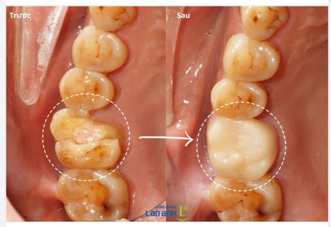 Răng sâu lớn đã điều trị tủy - giữ răng như thế nào?