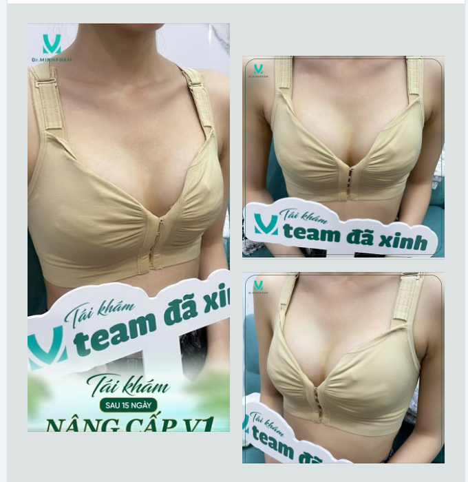 TÁI KHÁM SAU 15 NGÀY – FORM NGỰC ĐÃ CÂN ĐỐI HƠN RÕ RỆT
