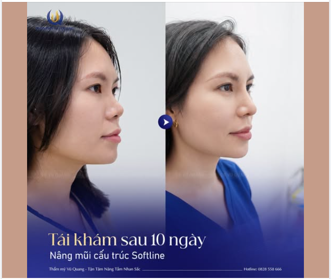 Nhìn lại thành quả sau 10 ngày tái khám nâng mũi cấu trúc Softline.