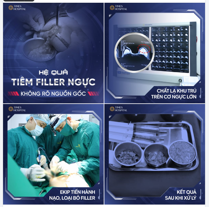 CẢNH BÁO: HỆ QUẢ KHI TIÊM FILLER NGỰC KHÔNG RÕ NGUỒN GỐC