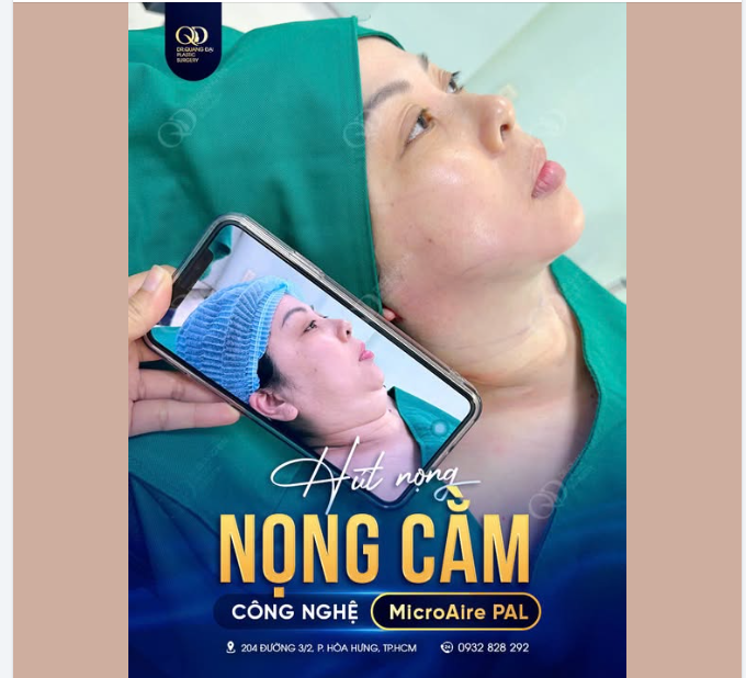 THU GỌN NỌNG CẰM: GỌN VÙNG DƯỚI CẰM, RÕ ĐƯỜNG VIỀN HÀM