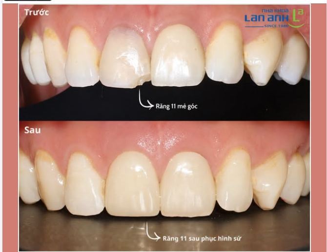 Một góc răng mẻ chẳng sao,  Miễn là phục hình đúng vào chuyên môn.