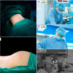 LÀM 1 ĐẸP 2 - CÙNG COMBO HÚT MỠ CẤY MÔNG TẠI THẨM MỸ BỆNH VIỆN HỒNG NGỌC