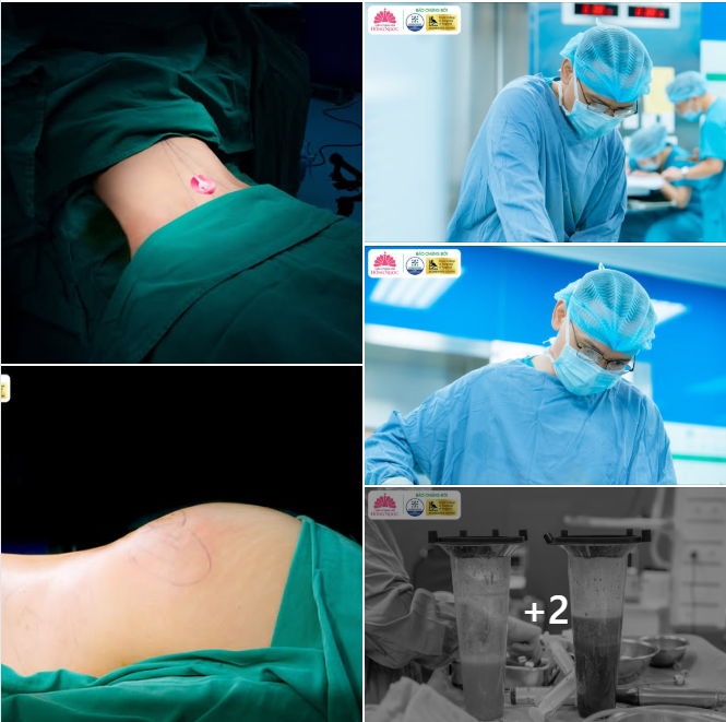 LÀM 1 ĐẸP 2 - CÙNG COMBO HÚT MỠ CẤY MÔNG TẠI THẨM MỸ BỆNH VIỆN HỒNG NGỌC